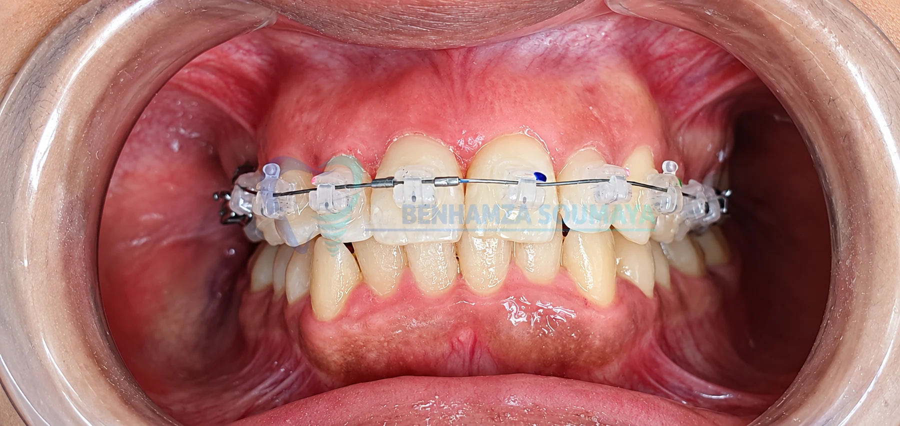 Brackets esthétiques