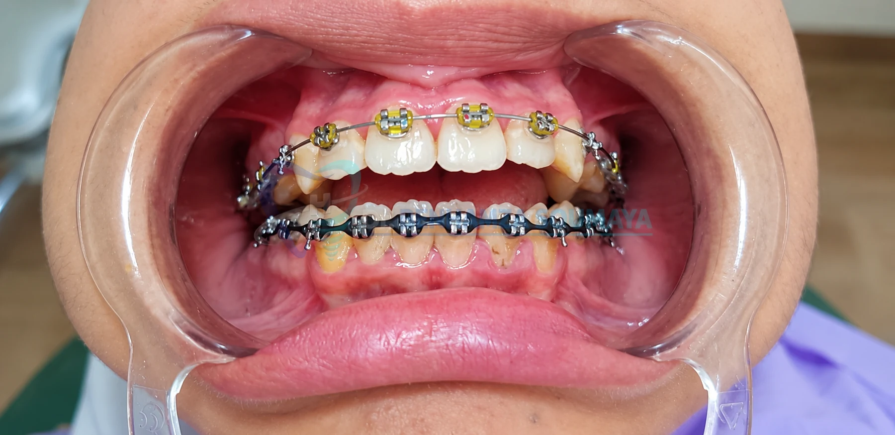 Orthodontie · étape 2