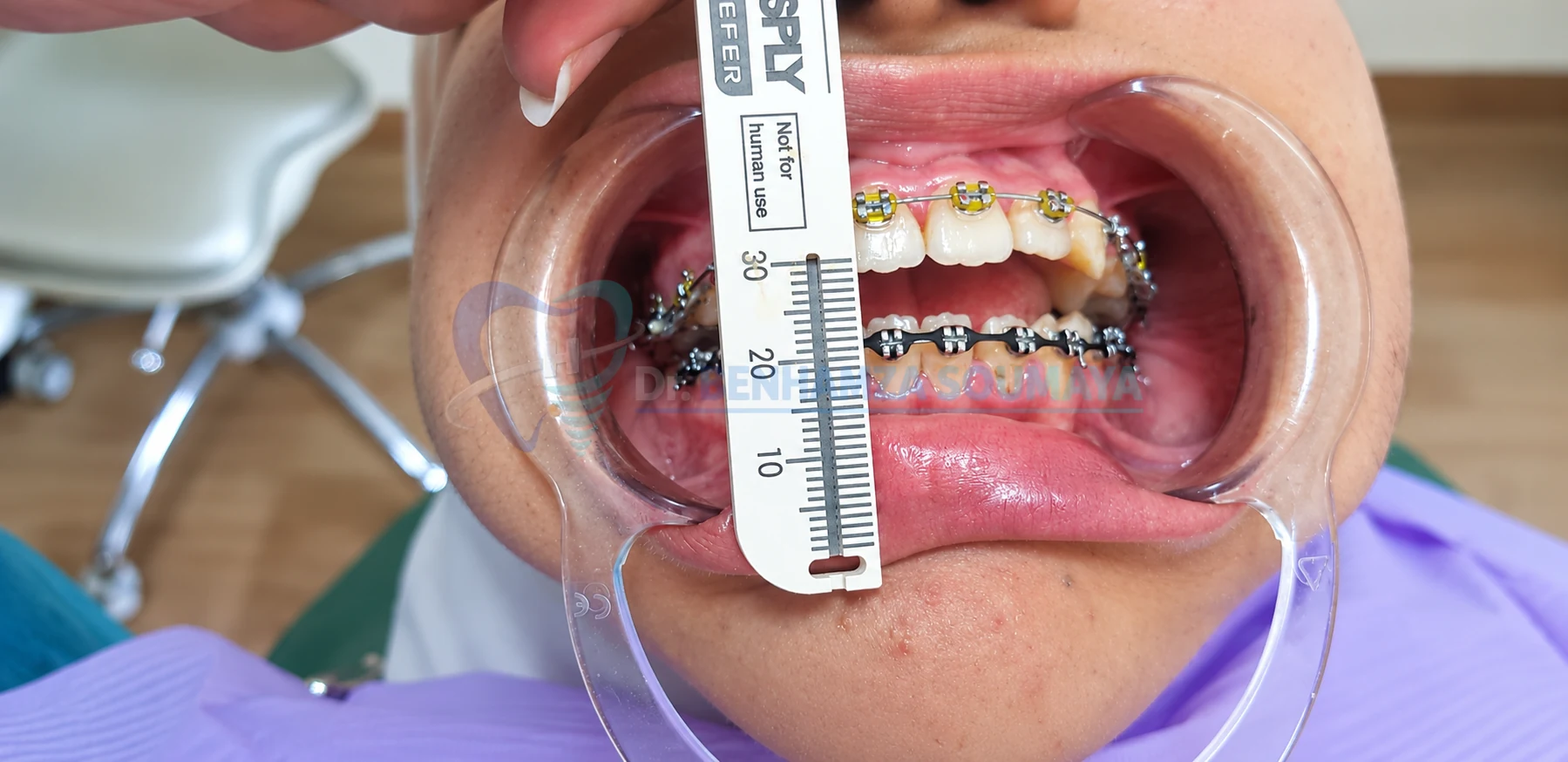 Orthodontie après
