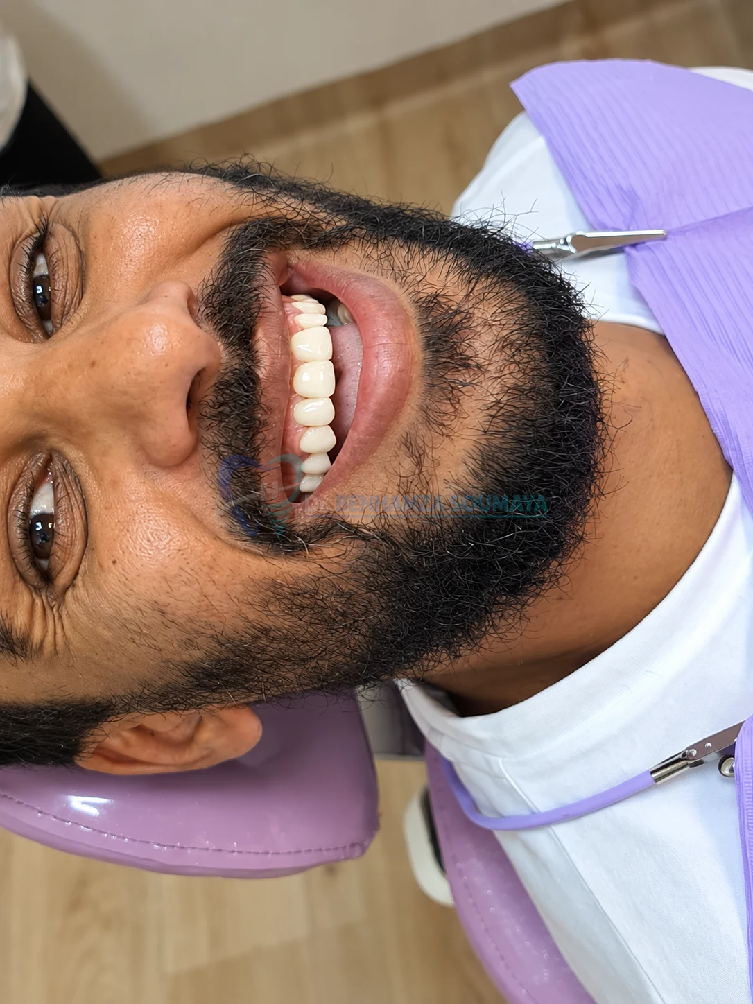 Facettes céramique homme smile design avant après, Smile's Centre El Jadida