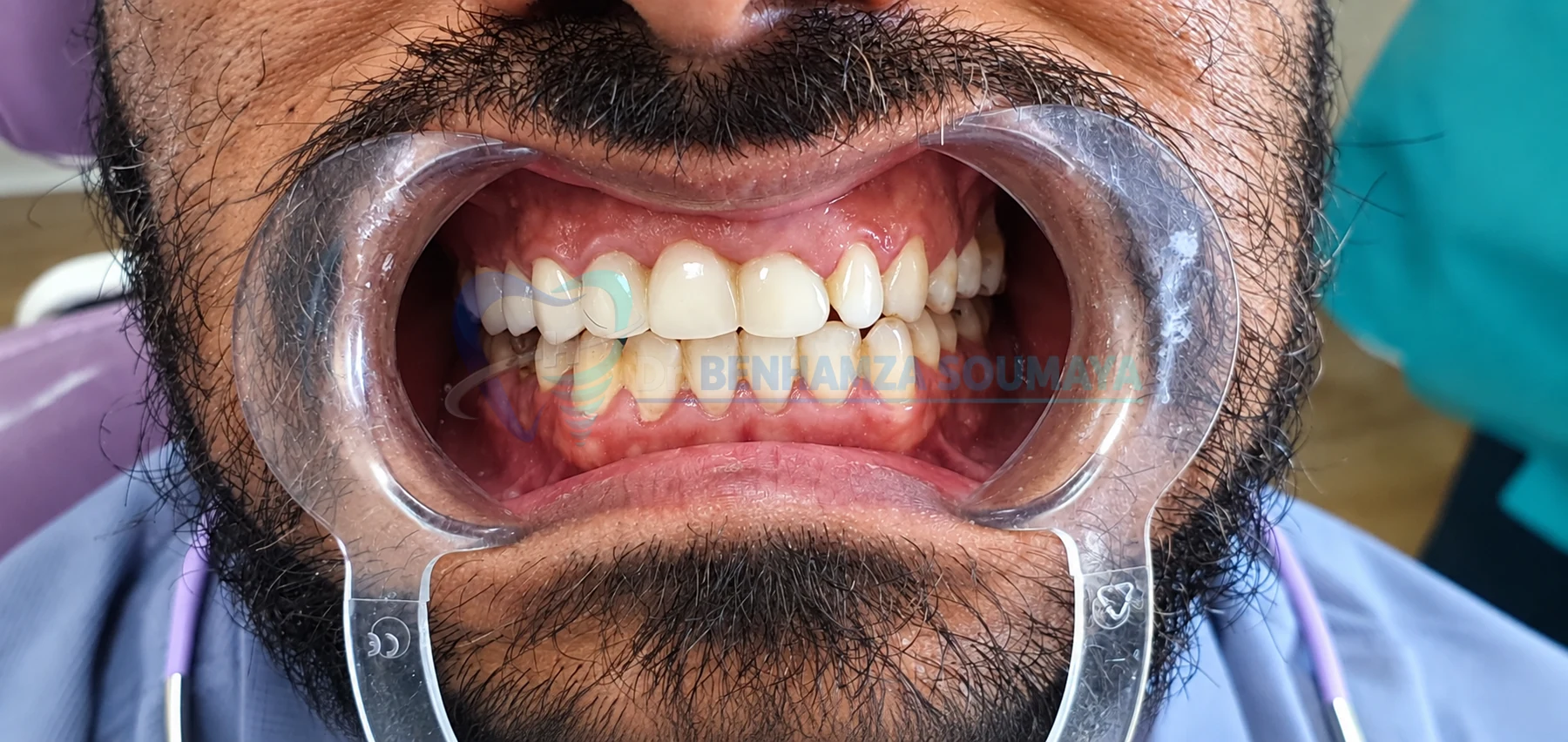 Résultat clinique blanchiment — Avant · Smile's Centre El Jadida